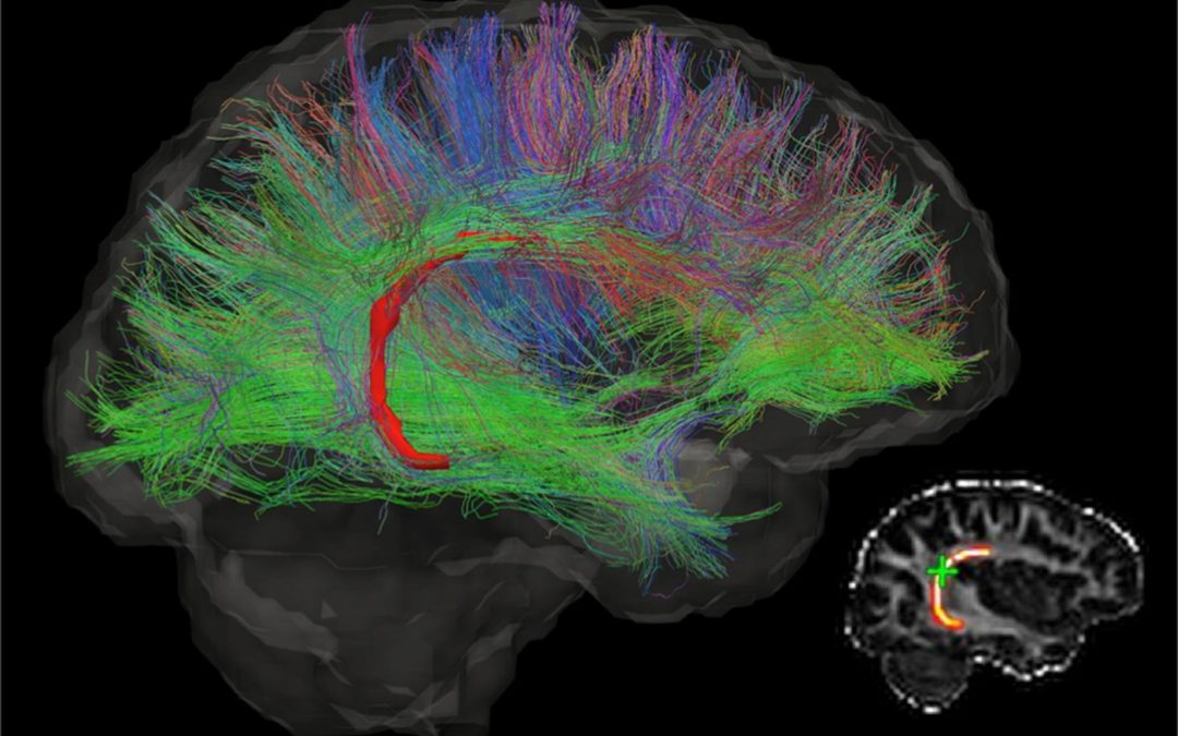 Ecco come la musica ha modificato il cervello, il fasciolo arcuato, del soggetto